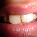 Zahnzusatzversicherungen im Vergleich